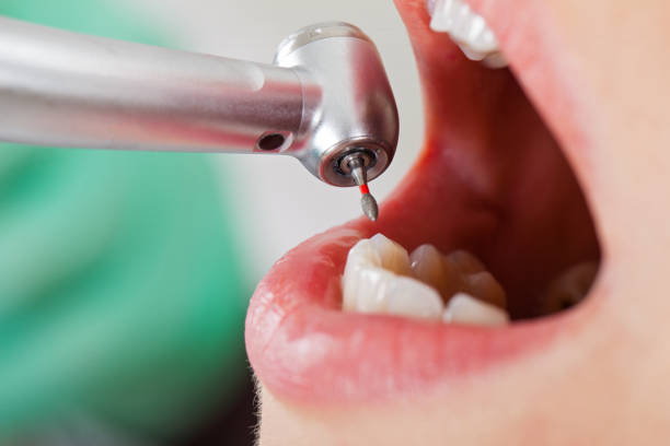 Best Emergency Tooth Extraction in Lake Elmo, MN